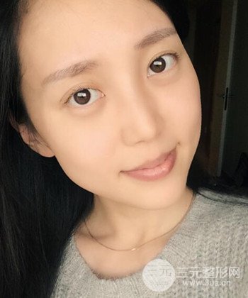 深圳内切去眼袋+硅胶垫下巴真实案例恢复果图