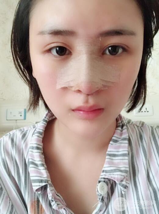 重庆五洲范文亮隆鼻整形案例，前后对比图分享