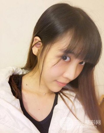 北京吸脂瘦脸真人案例恢复过程分享，巴掌小脸不是梦