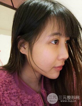 北京吸脂瘦脸真人案例恢复过程分享，巴掌小脸不是梦