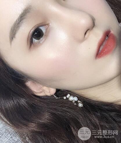 苏北人民医院李平松双眼皮案例日记