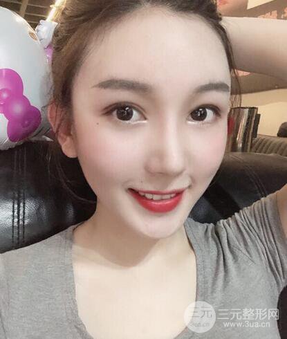 苏北人民医院李平松双眼皮案例日记