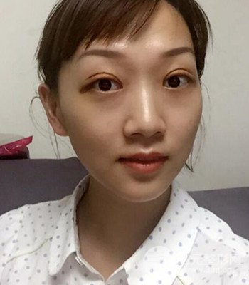 北京双眼皮失败修复手术日记分享，附上前后对比照片