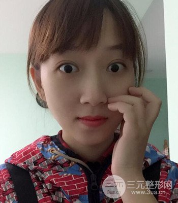 北京双眼皮失败修复手术日记分享，附上前后对比照片