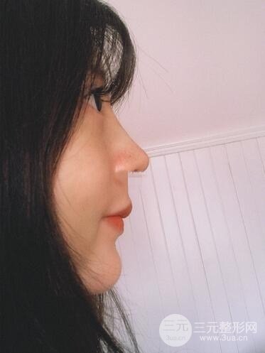 夏正义做鼻子怎么样？隆鼻案例日记记录