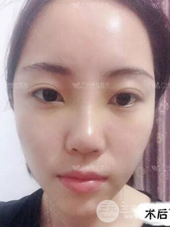 广州博仕隆鼻失败修复案例，前后恢复过程分享~