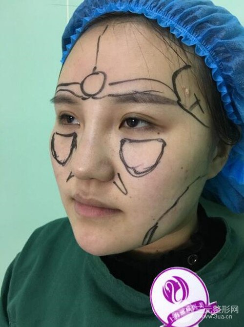 上海丽质吕成医生做的吸脂瘦脸日记，前后恢复图分享