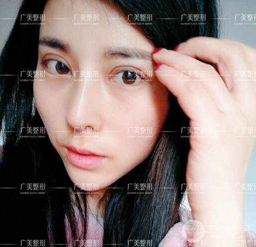 广州广美李晓平医生双眼皮整形日记分享