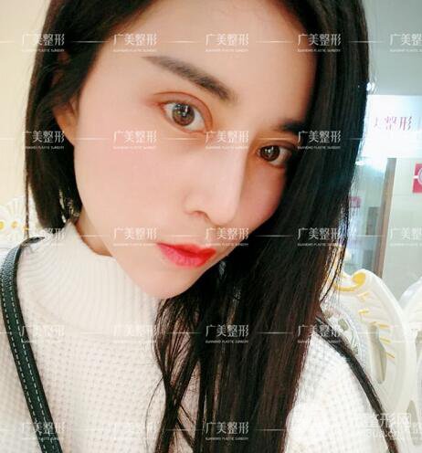广州广美李晓平医生双眼皮整形日记分享