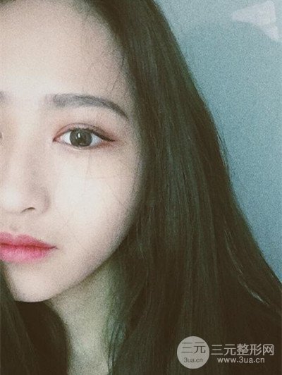 广州曙光刘杰伟医生切开双眼皮案例，前后对比图分享