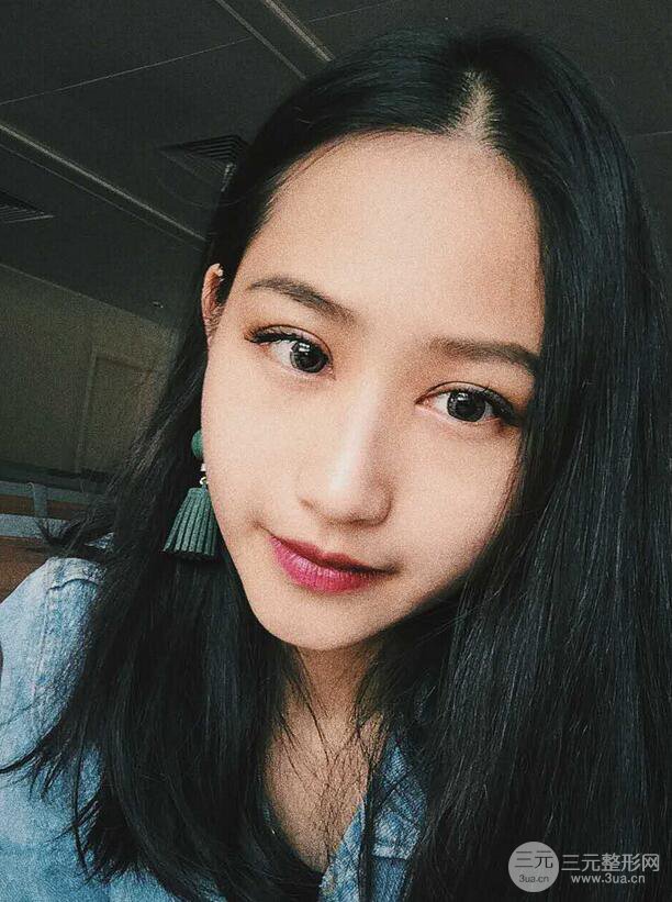 广州曙光刘杰伟医生切开双眼皮案例，前后对比图分享