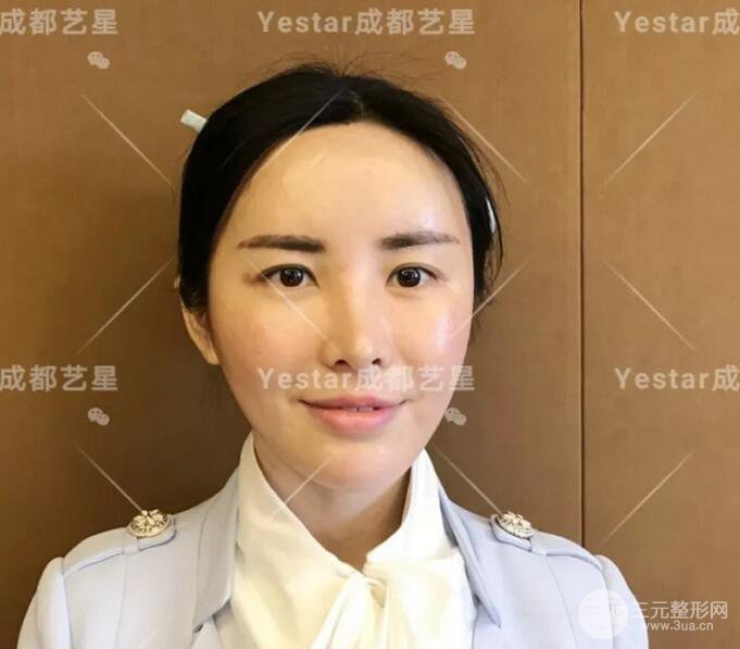 成都艺星蔡灵自体脂肪面部填充术后果记录