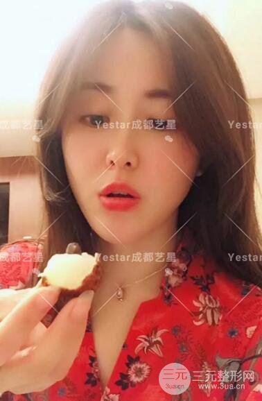 成都艺星蔡灵自体脂肪面部填充术后果记录