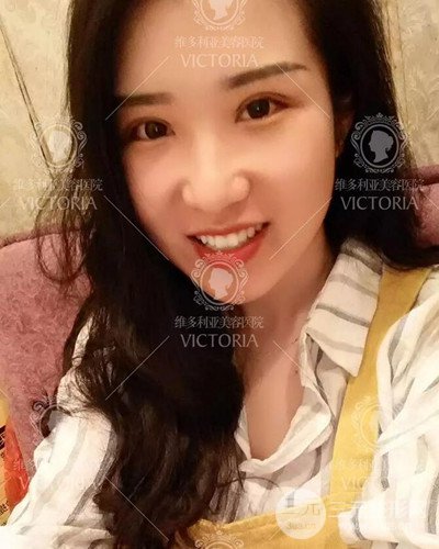 南京维多利亚切开双眼皮+开眼角案例分享，附上前后对比图