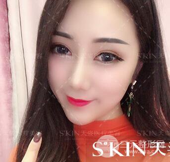 汪海滨双眼皮+隆鼻案例术后100天日记~