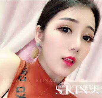 汪海滨双眼皮+隆鼻案例术后100天日记~