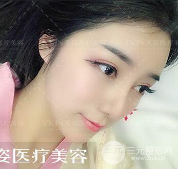 汪海滨双眼皮+隆鼻案例术后100天日记~