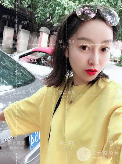 成都恒博发际线种植恢复过程分享