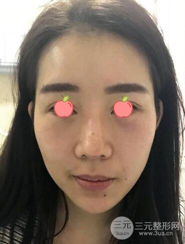 伊美尔王飏医生自体脂肪填充案例实记