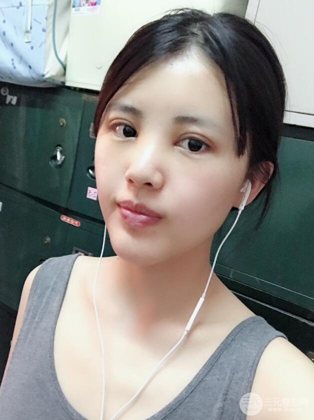 北京禾美嘉任学会自体脂肪面部填充案例分享