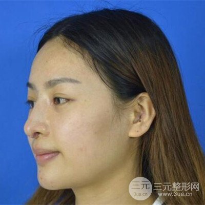 广州艺美李闯医生隆鼻整形恢复记录分享~