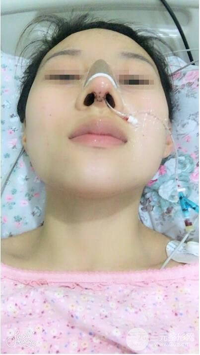 武汉亚太程晓林做鼻子好吗？隆鼻案例日记