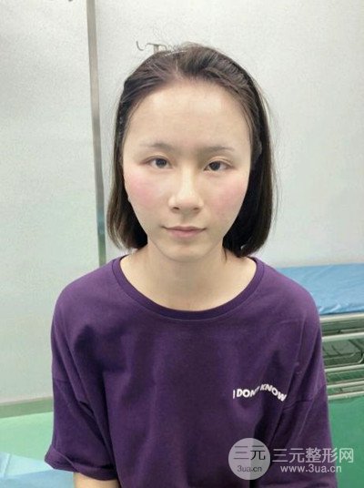 武汉伊美馨桂亮医生自体脂肪填充面部前后对比图恢复日记分享~