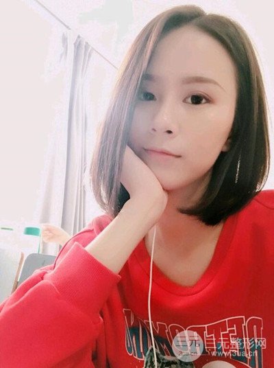 武汉伊美馨桂亮医生自体脂肪填充面部前后对比图恢复日记分享~