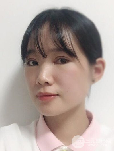 广州晨曦切开双眼皮恢复日记分享，附上前后对比图