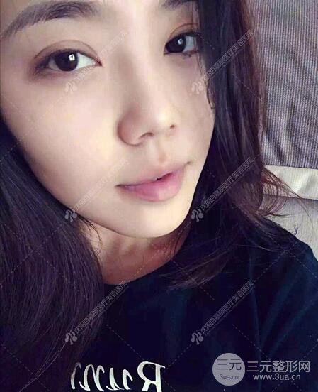 沈阳百嘉丽侯亚杰光纤溶脂瘦脸恢复日记