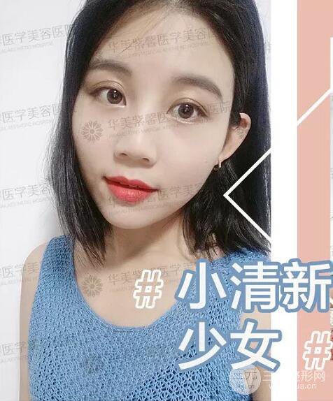 四川华美紫馨自体脂肪面部案例术后恢复日记