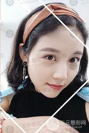 四川华美紫馨自体脂肪面部案例术后恢复日记