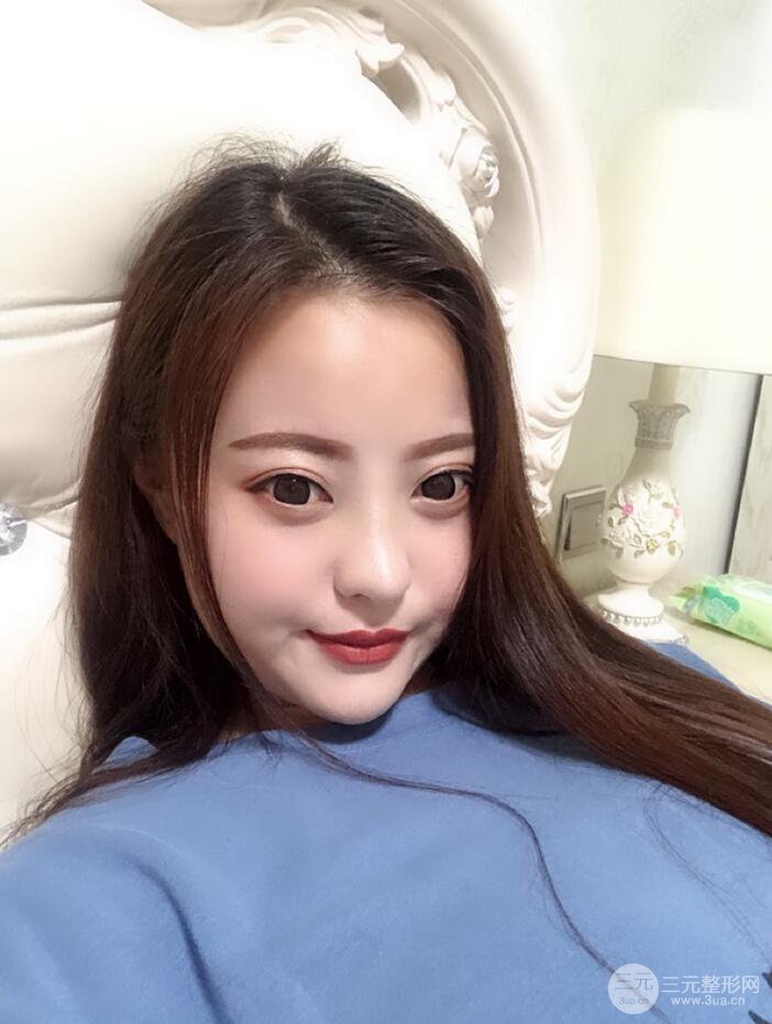 太原丽都面部吸脂+假体隆鼻案例分享，精致面部小V脸了解一下~