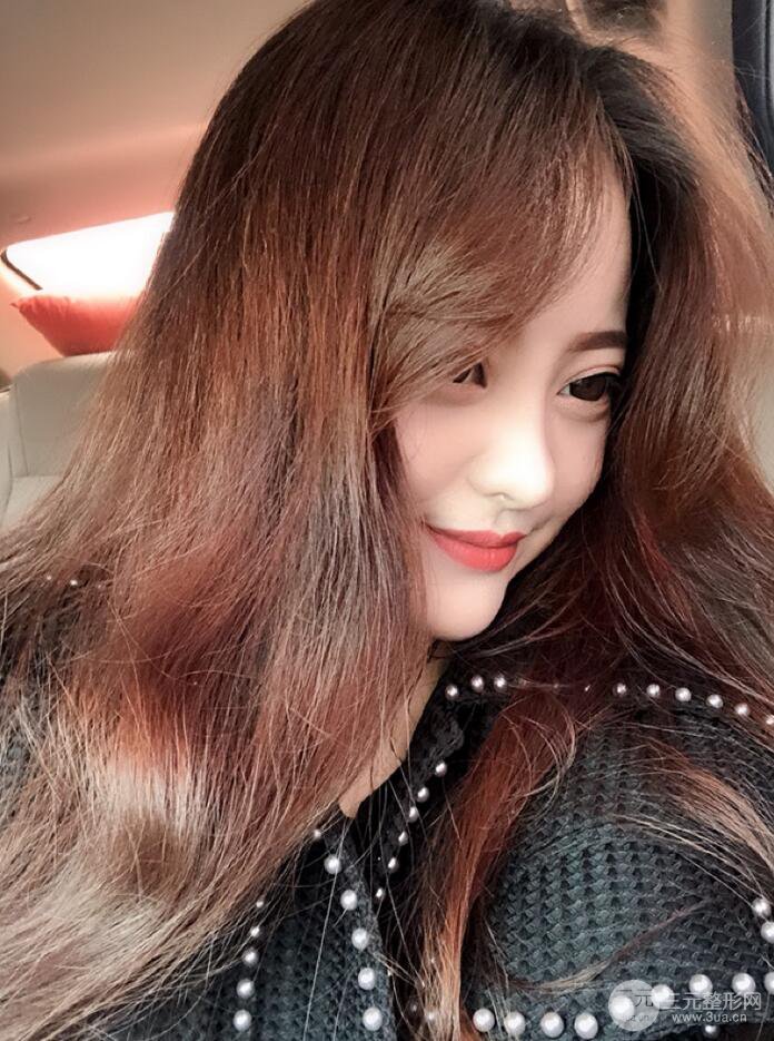 太原丽都面部吸脂+假体隆鼻案例分享，精致面部小V脸了解一下~