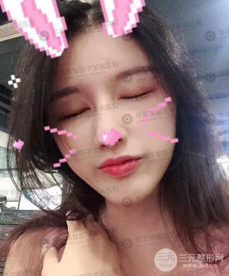 四川华美紫馨艾玉峰自体脂肪填充案例术后日记