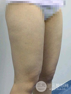 成都艾米丽潘红伟大腿吸脂案例恢复过程分享
