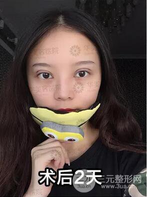华美紫馨邱伟双眼皮案例术后7天果图分享
