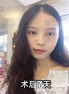 华美紫馨邱伟双眼皮案例术后7天果图分享