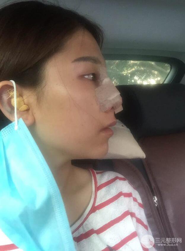 成都武侯星范刘向文自体耳软骨隆鼻案例分享