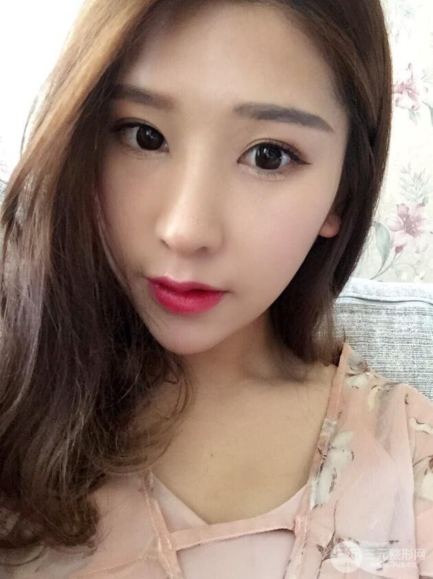 成都武侯星范刘向文自体耳软骨隆鼻案例分享