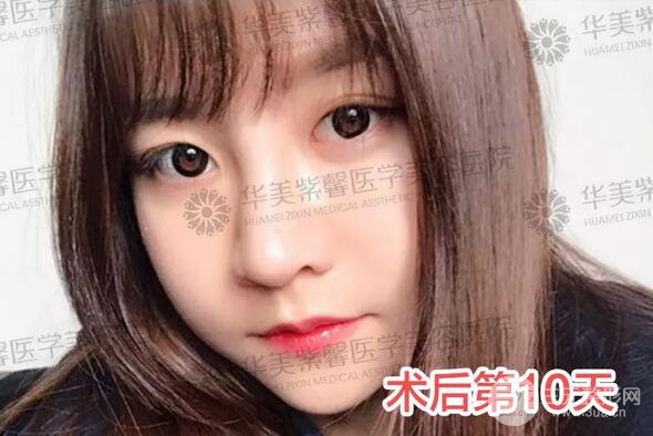 华美紫馨邱伟做的隆鼻术后10天惊人果分享！