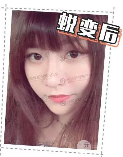 华美紫馨邱伟做的隆鼻术后10天惊人果分享！