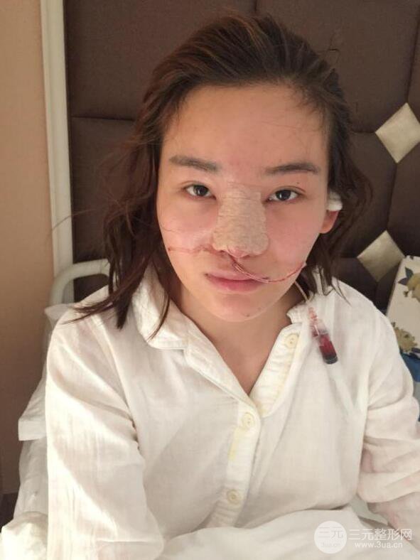 南京华美曹海峰隆鼻整形日记恢复图片分享~