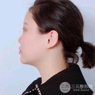 北京协和刘志飞隆鼻修复案例恢复过程日记分享