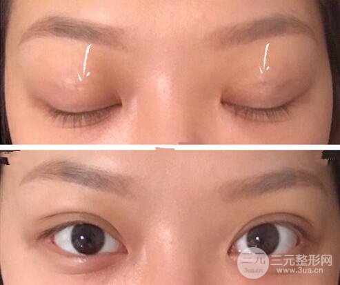 中山一院苏爱云双眼皮案例日记记录