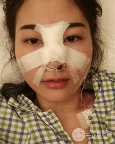 膨体隆鼻案例分享，四川华人医疗游晓波医生做的!