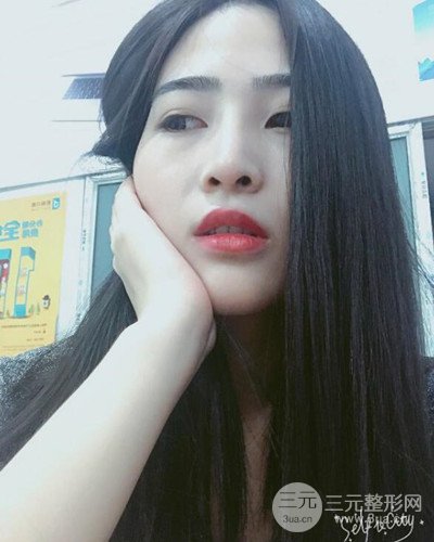 膨体隆鼻案例分享，四川华人医疗游晓波医生做的!