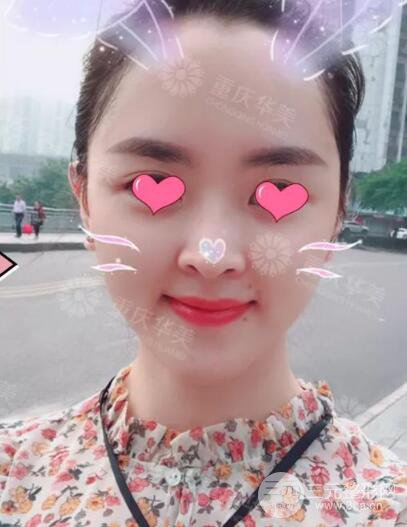 四川华美紫馨秦晓自体脂肪填充案例合集