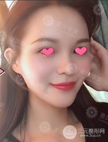 四川华美紫馨秦晓自体脂肪填充案例合集