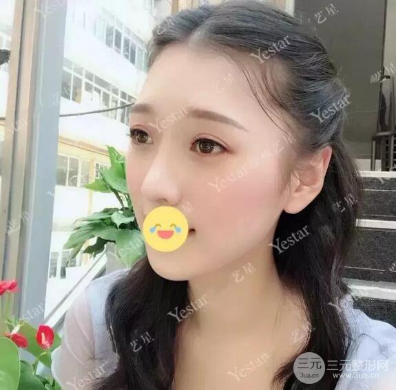 成都艺星6d明星眼双眼皮术后恢复日记